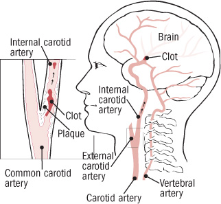 illustration showing brain and carotid arteries