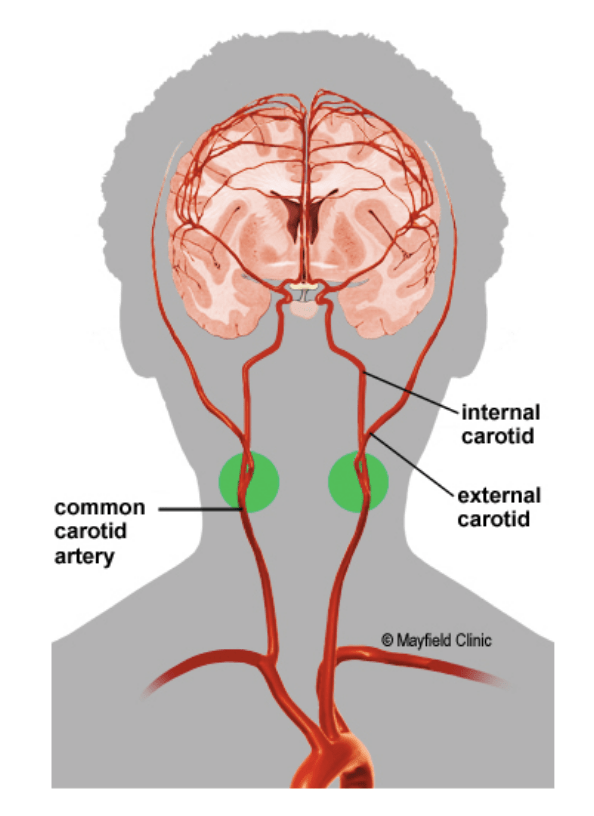 Carotid-Artery-Stenosis.png