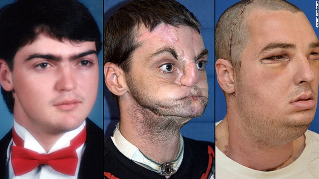 151116162453-new-face-transplant-richard-norris-super-169.jpg